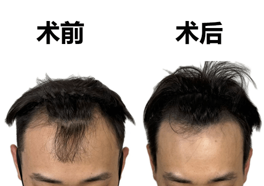 M型发际线改善效果