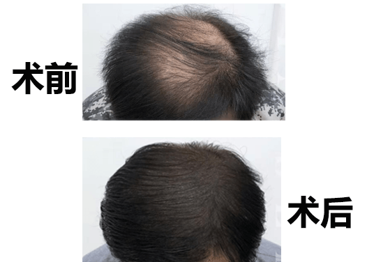 头顶稀疏加密效果