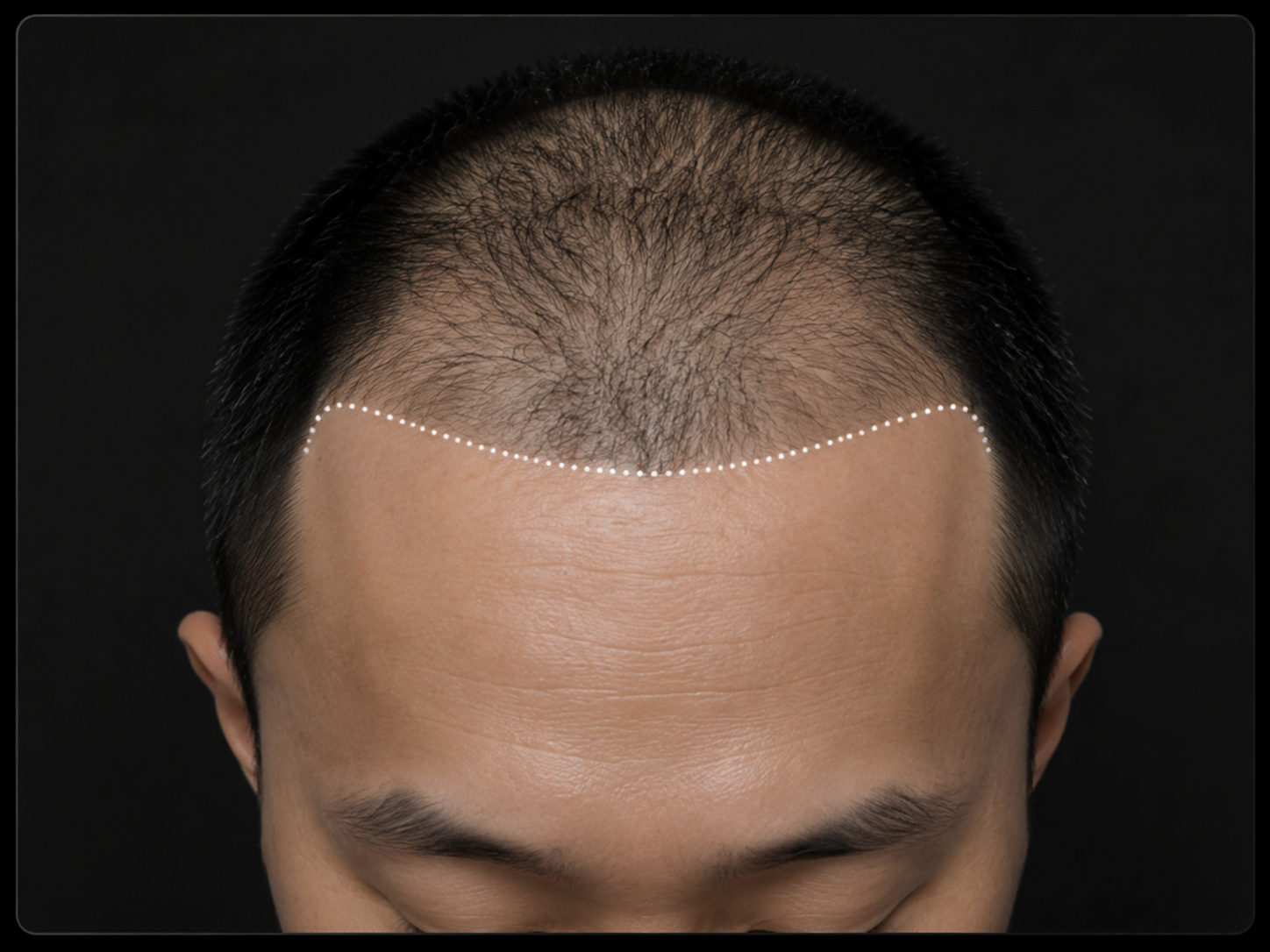 发际线设计项目头图
